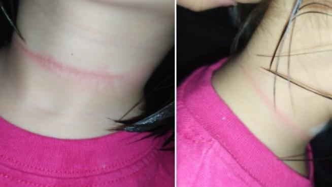 La niña terminó con marcas en el cuello al intentar imitar un video. 