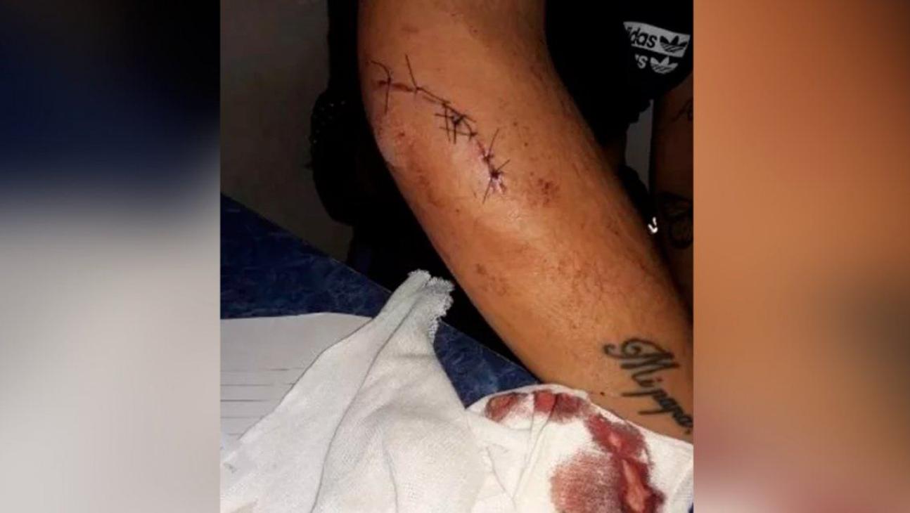 La joven tuvo que ser atendida por los médicos a causa de la herida sufrida en el brazo.