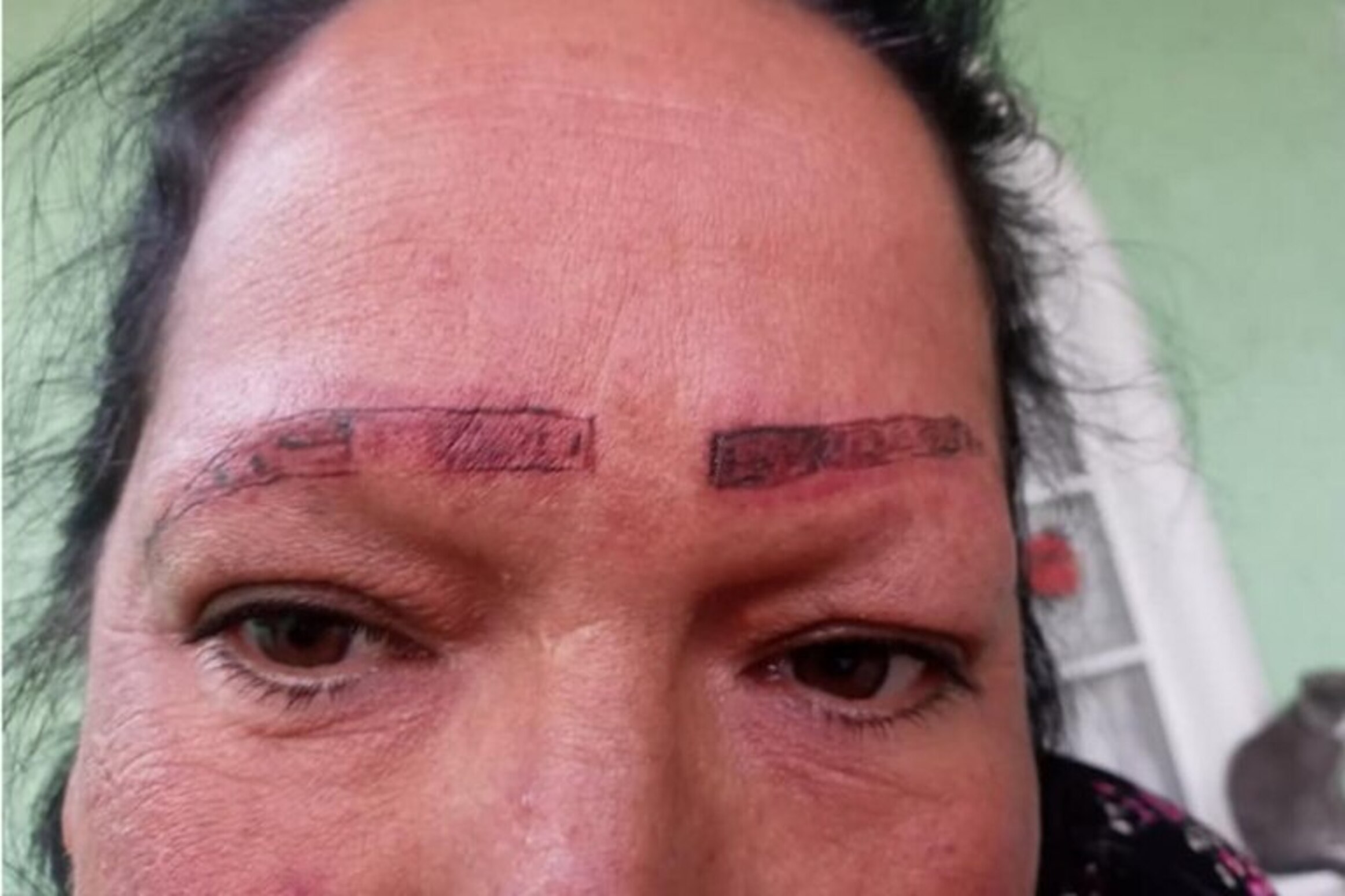 Una mujer se fue a tatuar las cejas y terminó con cicatrices y quemaduras en la cara.