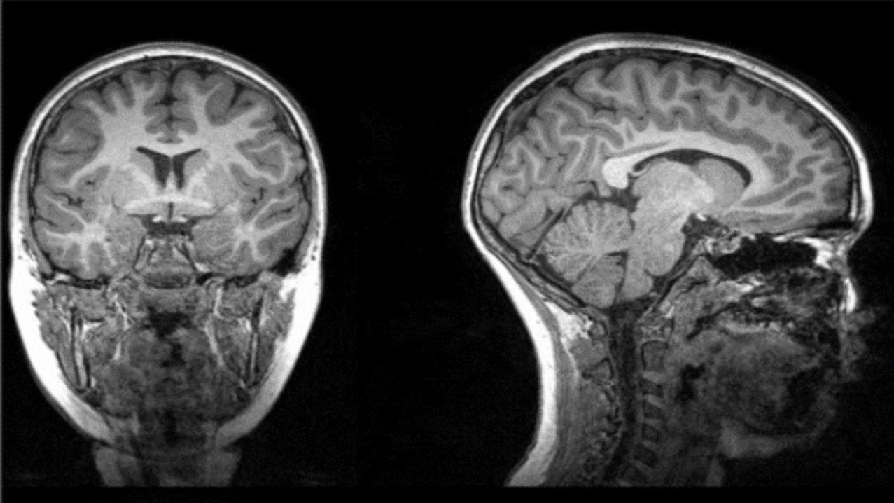 Se trata de un estudio con enfoque multivariable sobre cómo el Covid afecta al cerebro.