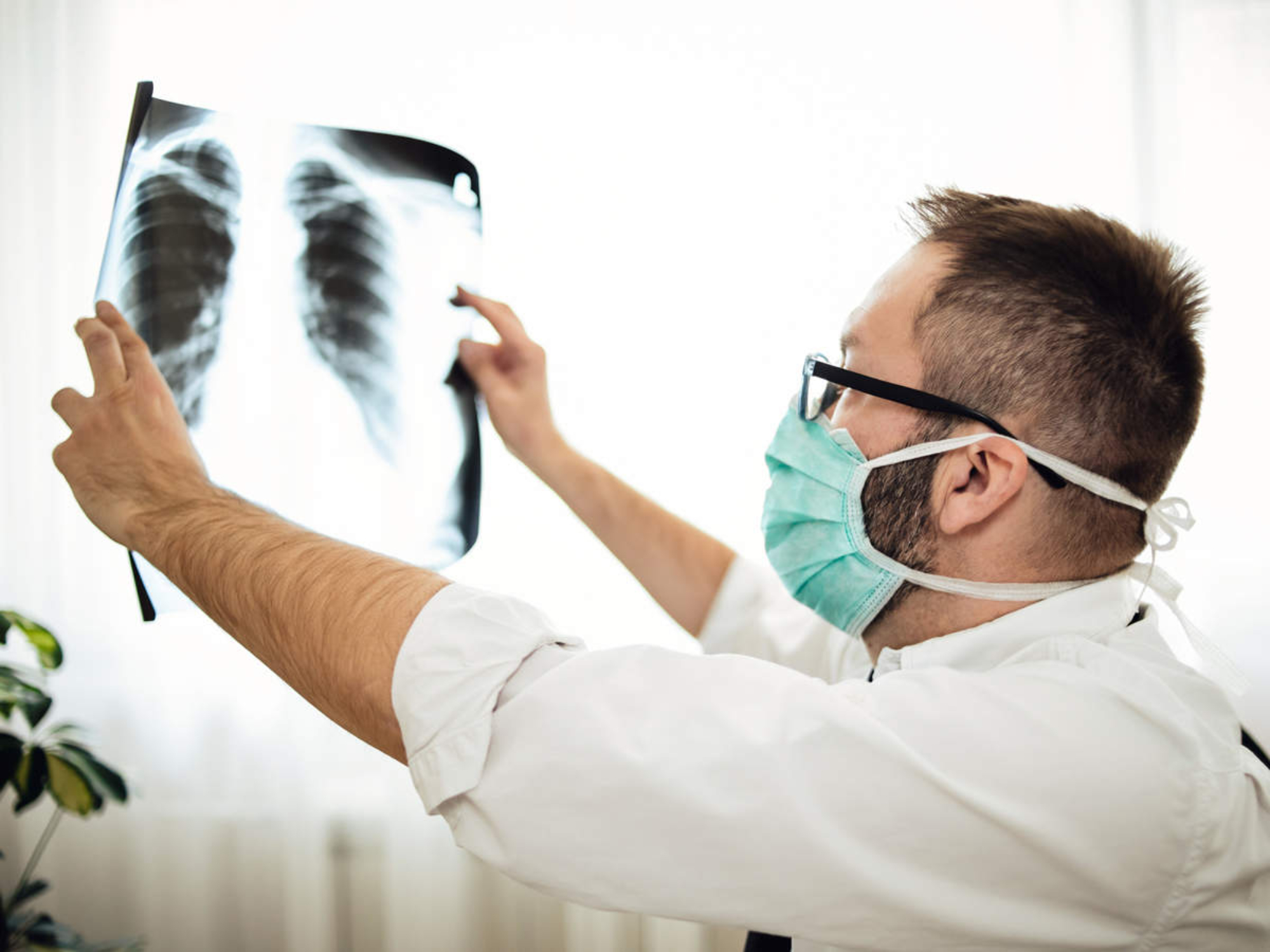 Los pacientes post Covid-19 muestran pulmones que parecen estar casi completamente blancos, es decir, severamente dañados.