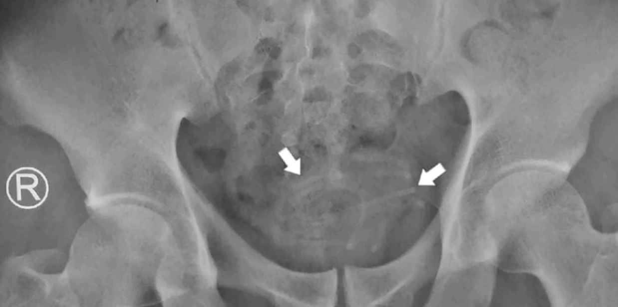 Los auriculares le causaban al paciente un dolor al orinar.