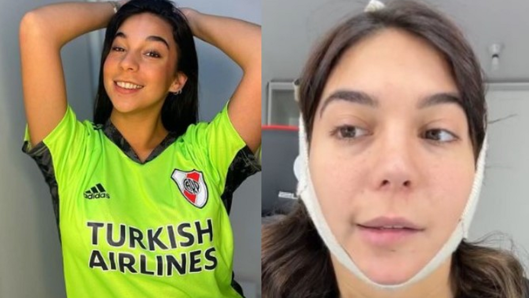 Luciana Milessi, la influencer que sufre una parálisis facial tras una cirugía estética. 