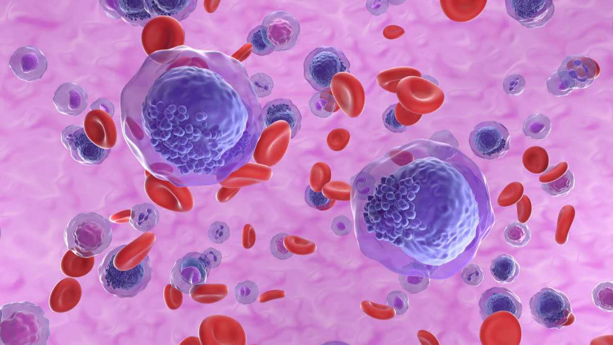  La leucemia es un cáncer que afecta la sangre y la médula ósea, donde se producen las células sanguíneas, incluyendo los glóbulos rojos, los glóbulos blancos y las plaquetas.